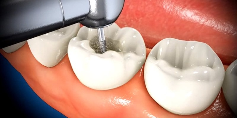 به تعویق انداختن عصب کشی دندان