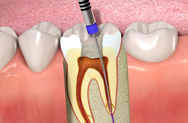 به تعویق انداختن عصب کشی دندان