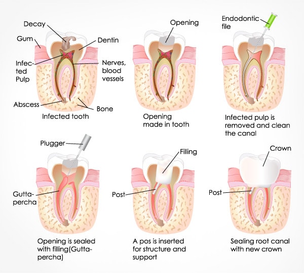 متخصص درمان ریشه دندان 