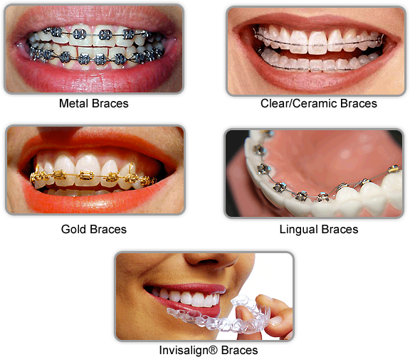 بهترین نوع ارتودنسی دندان