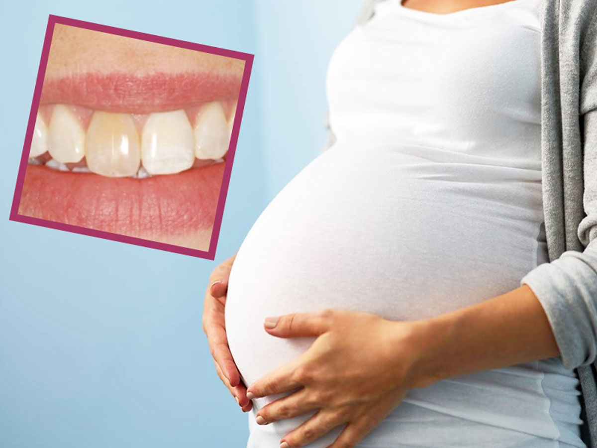 بلیچینگ دندان در دوران بارداری