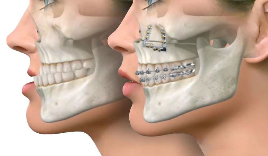 جراحی زیبایی چانه و تاثیر آن بر دندان ها