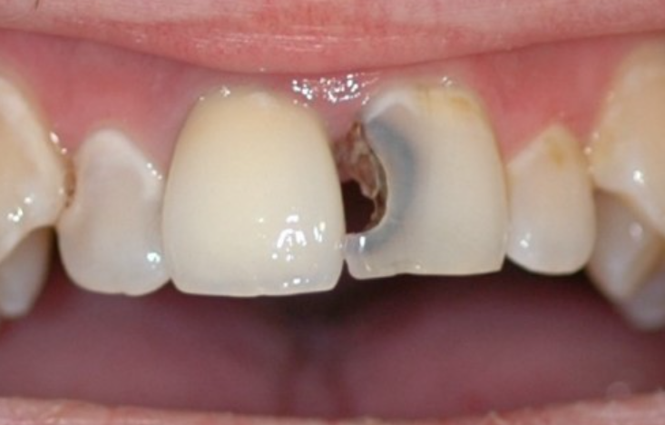 علائم پوسیدگی ریشه دندان