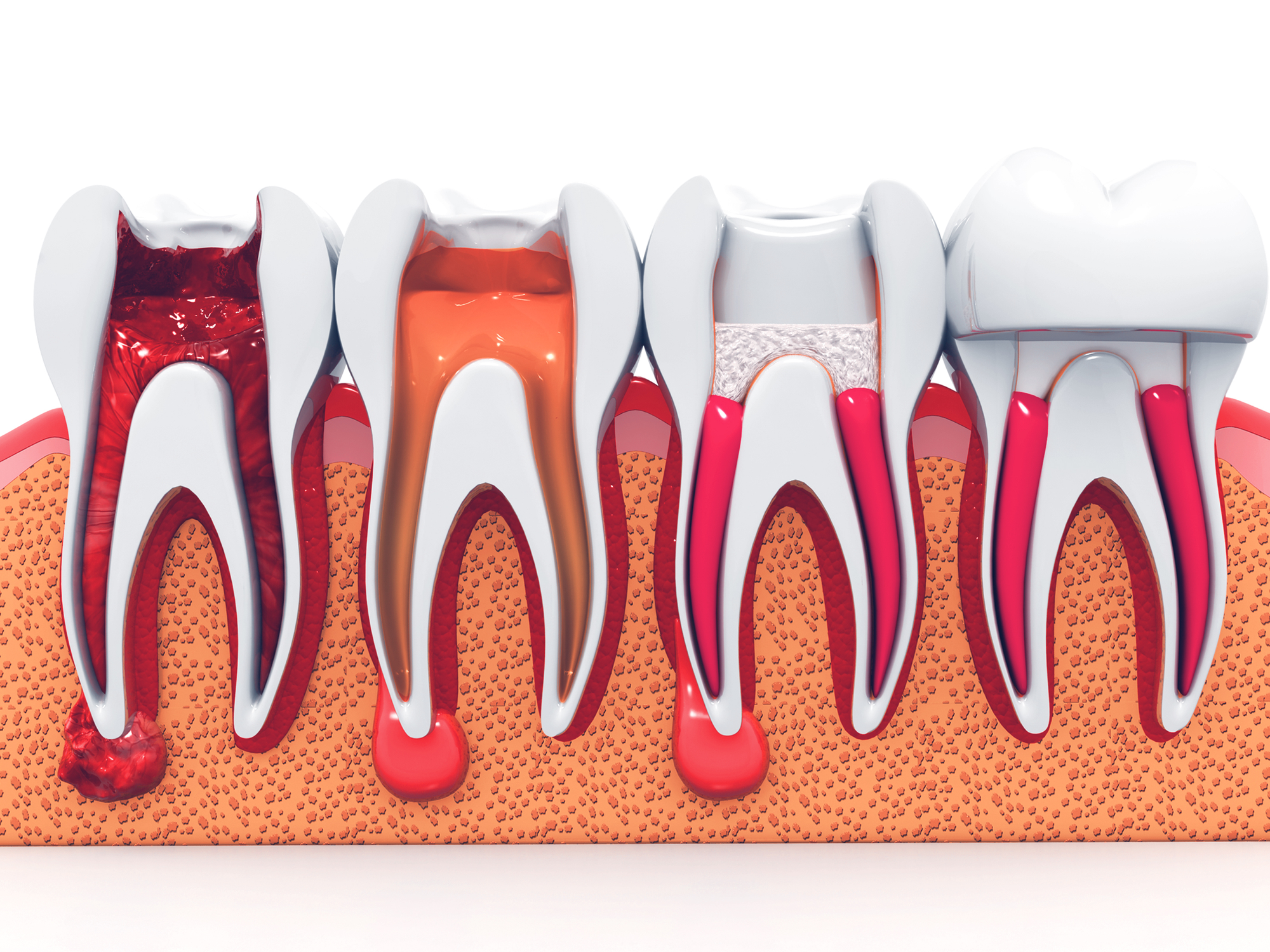 علائم پوسیدگی ریشه دندان
