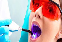 جرمگیری دندان با لیزر
