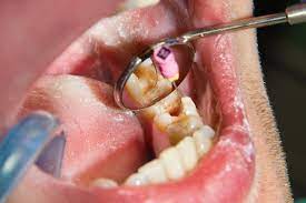 هزینه درمان ریشه دندان عفونی