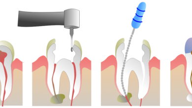 هزینه درمان ریشه دندان عفونی