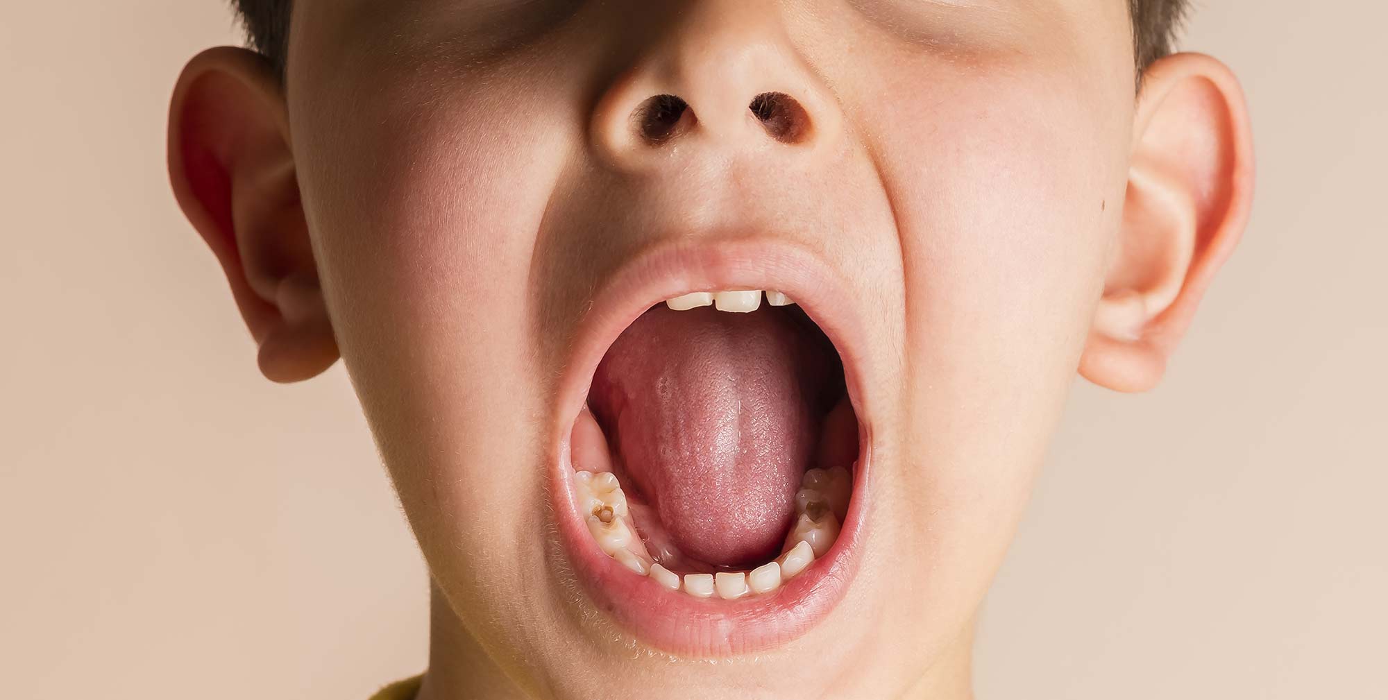 علت کج درآمدن دندان کودکان