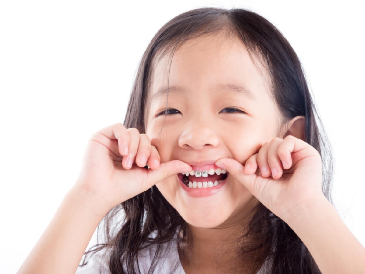 علت کج درآمدن دندان کودکان
