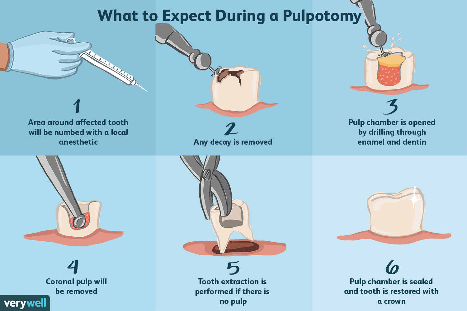 پالپوتومی دندان 