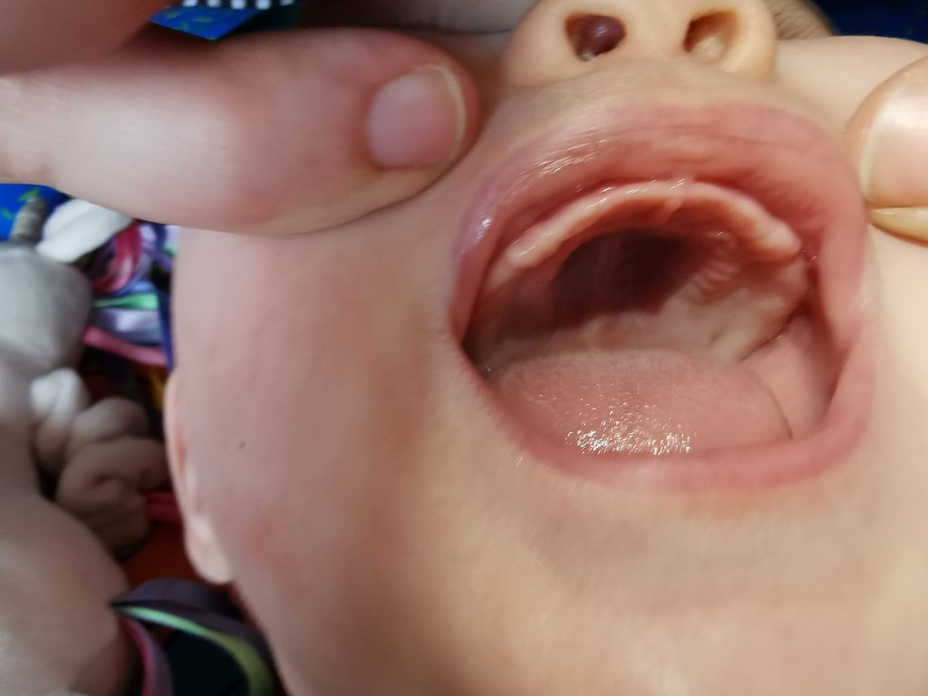 تاخیر در رویش دندان کودکان