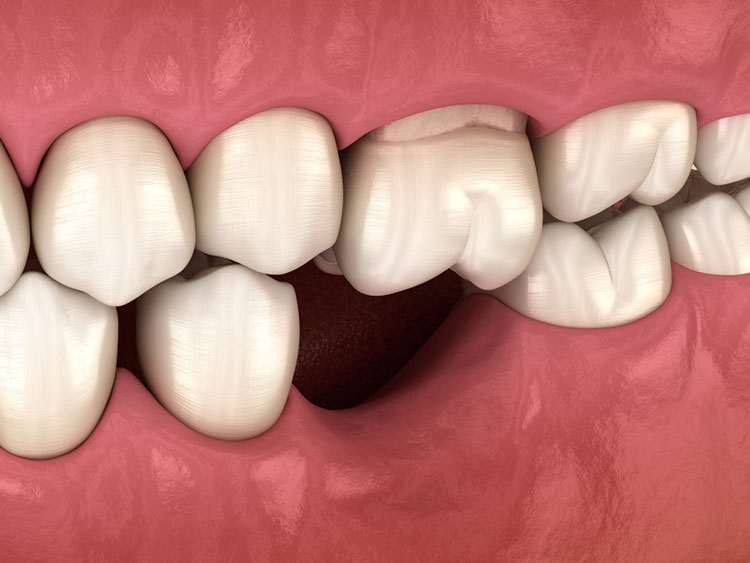 عوارض جای خالی دندان