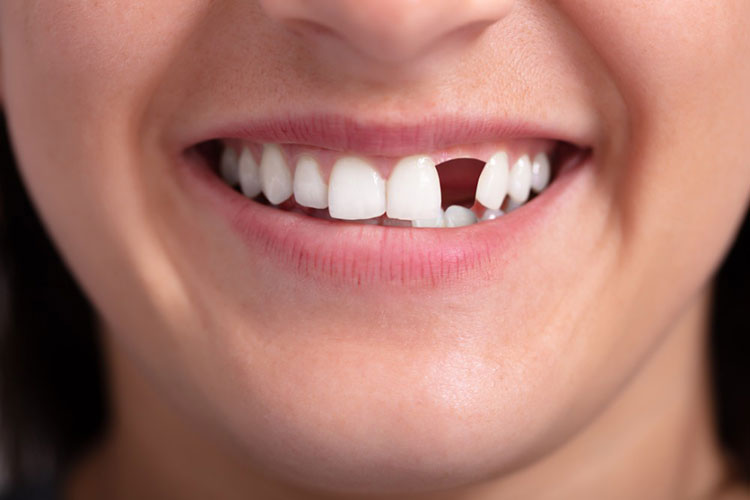 عوارض جای خالی دندان