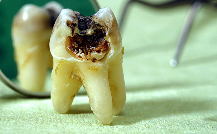 دندان انسان 