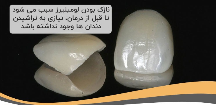 لومینیرز دندان
