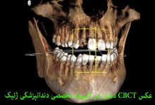 عکس CBCT دندان