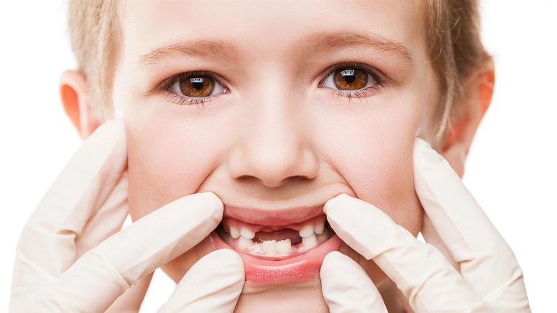 پالپوتومی یا عصب کشی دندان شیری