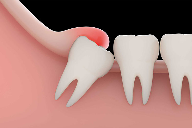 مراقبت های بعد از کشیدن دندان عقل 