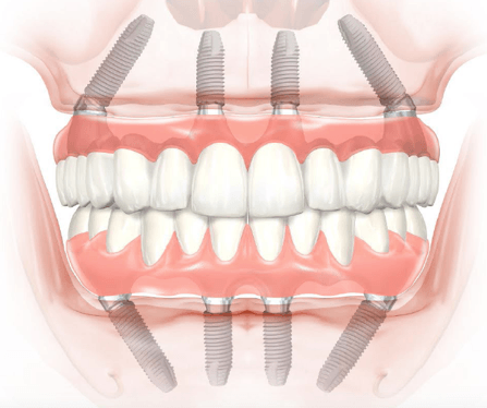 ایمپلنت دندان بر اساس روش کاشت