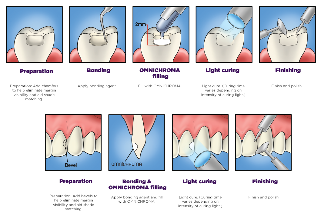 Steps of dental composite