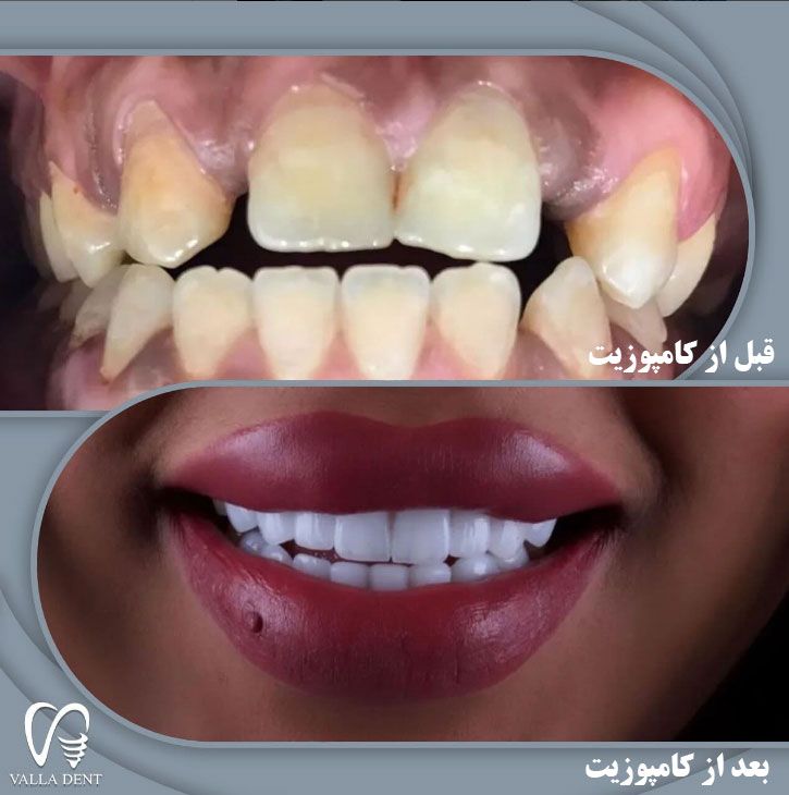 قبل-و-بعد-از-کامپوزیت دندان