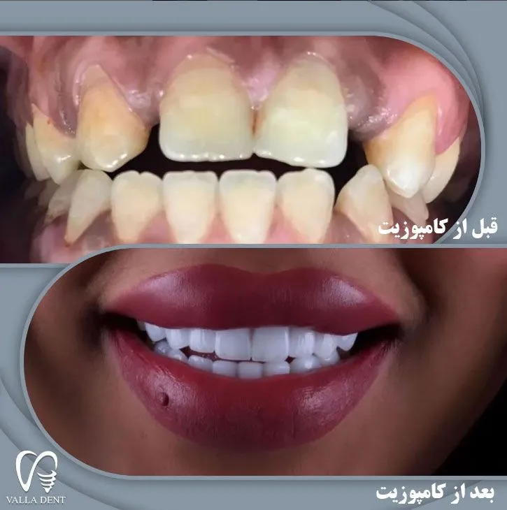 قبل-و-بعد-از-کامپوزیت دندان