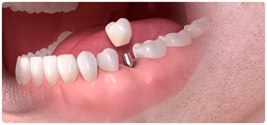 مزایا و ویژگی های ایمپلنت دندان