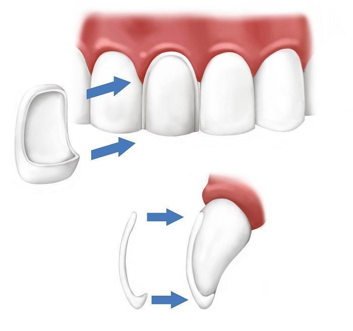 معایب استفاده از کامپوزیت دندان