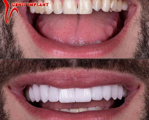 نمونه-کار-ایمپلنت-دندان