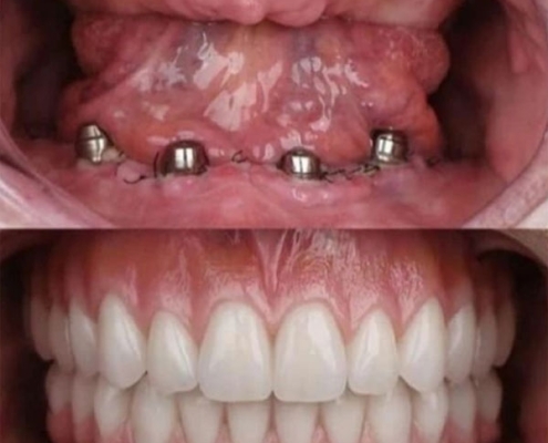 آسیب‌شناسی عمل جراحی ایمپلنت دندان