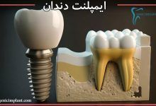 ایمپلنت-دندان