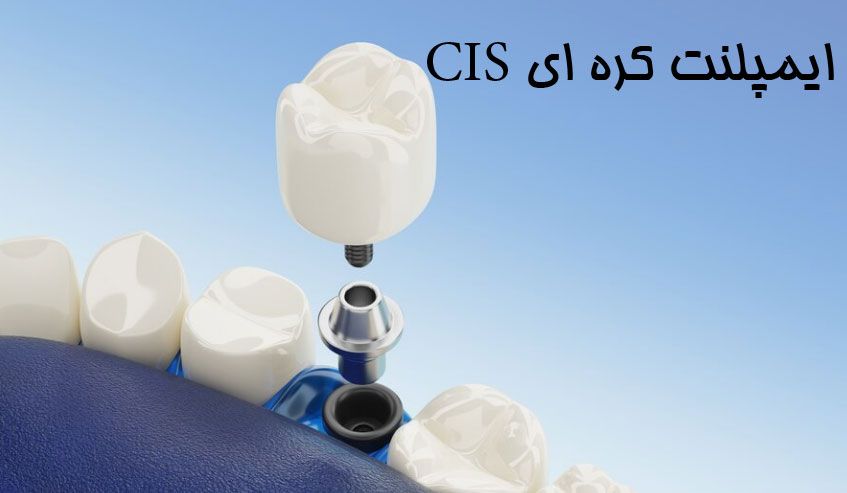 ایمپلنت-CIS