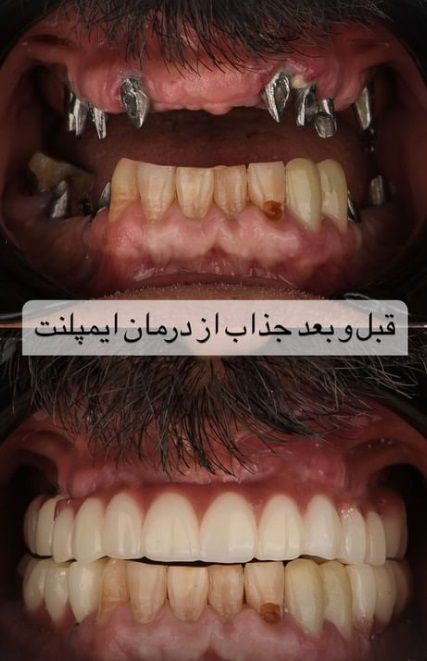 ایمپلنت اقساطی
