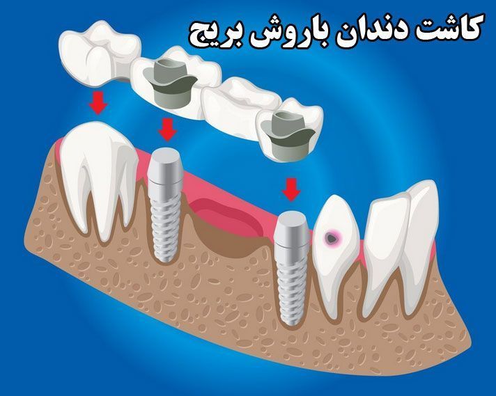 کاشت-دندان-با-روش-بریج