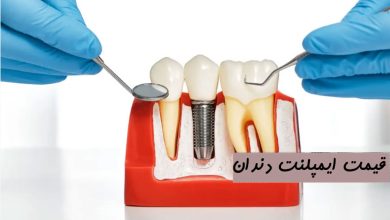 قیمت ایمپلنت دندان