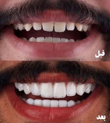 تصاویر قبل و بعد کامپوزیت دندان