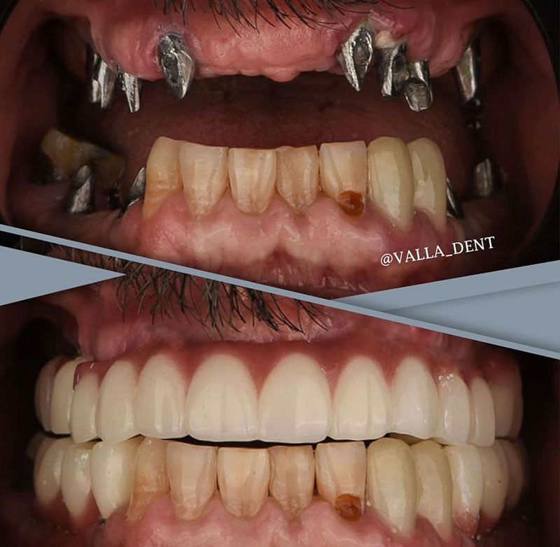 implant dental